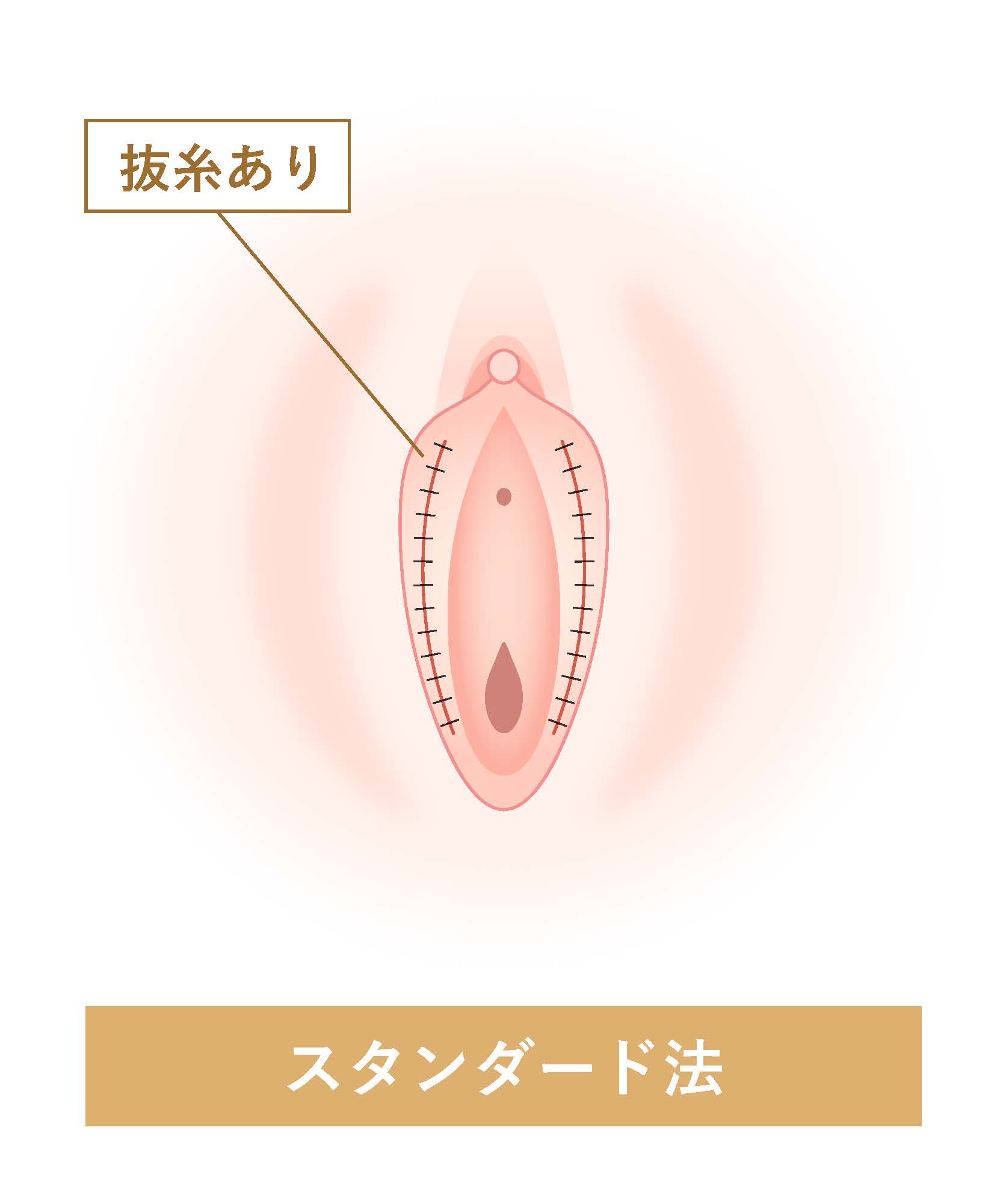 スタンダード法 抜糸あり