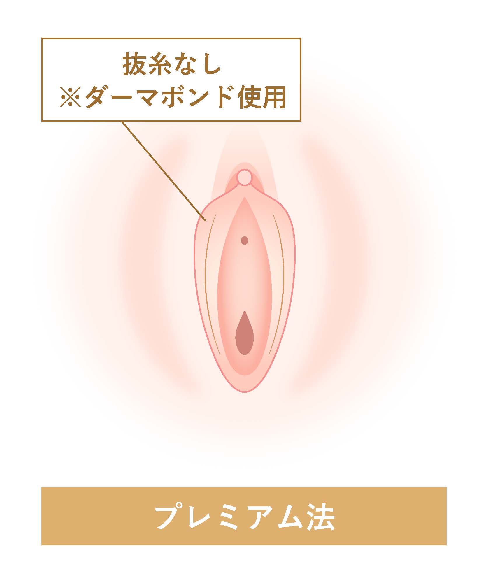 プレミアム法 抜糸なし※ダーマボンド使用