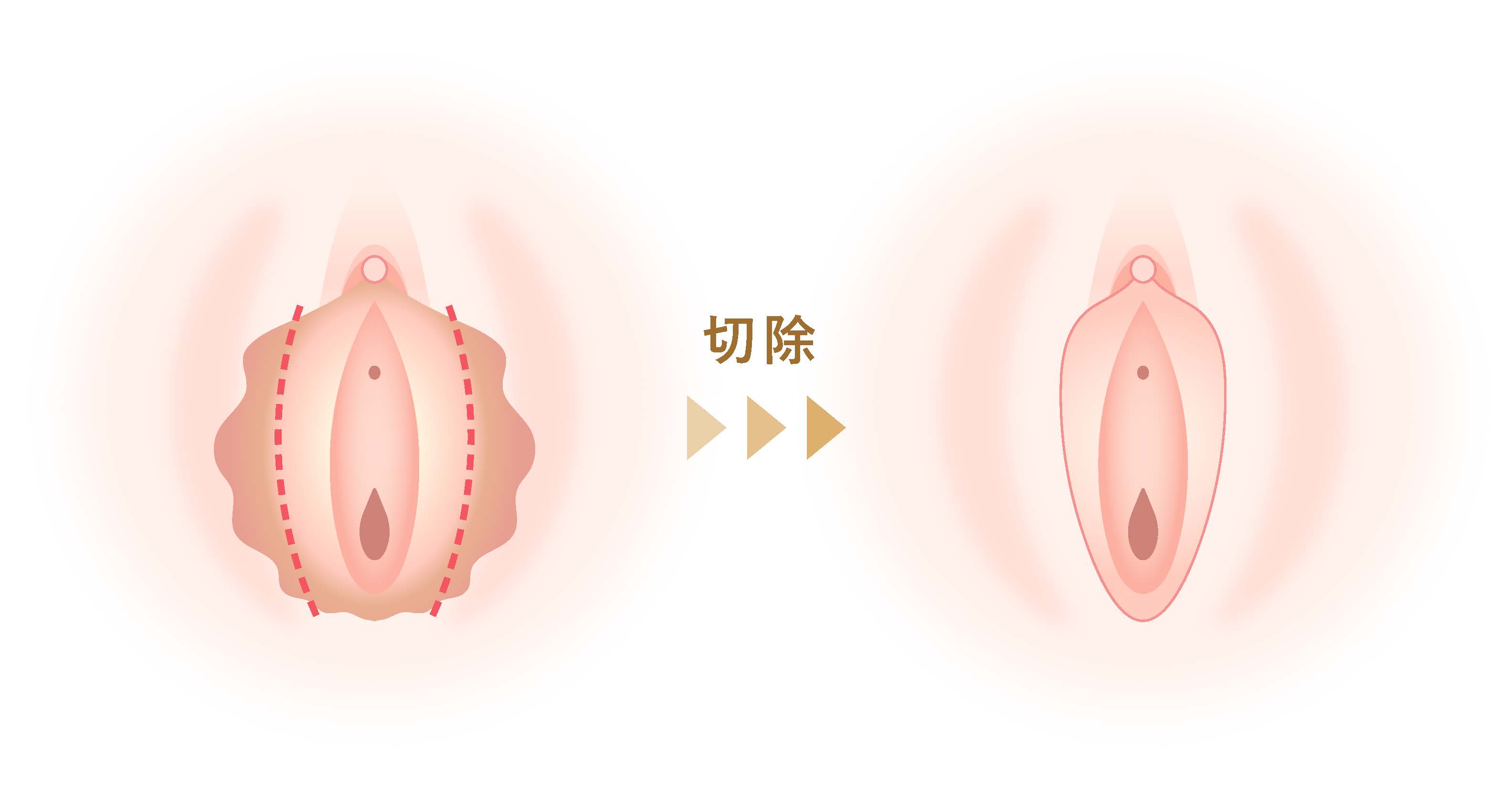 小陰唇縮小のイラスト