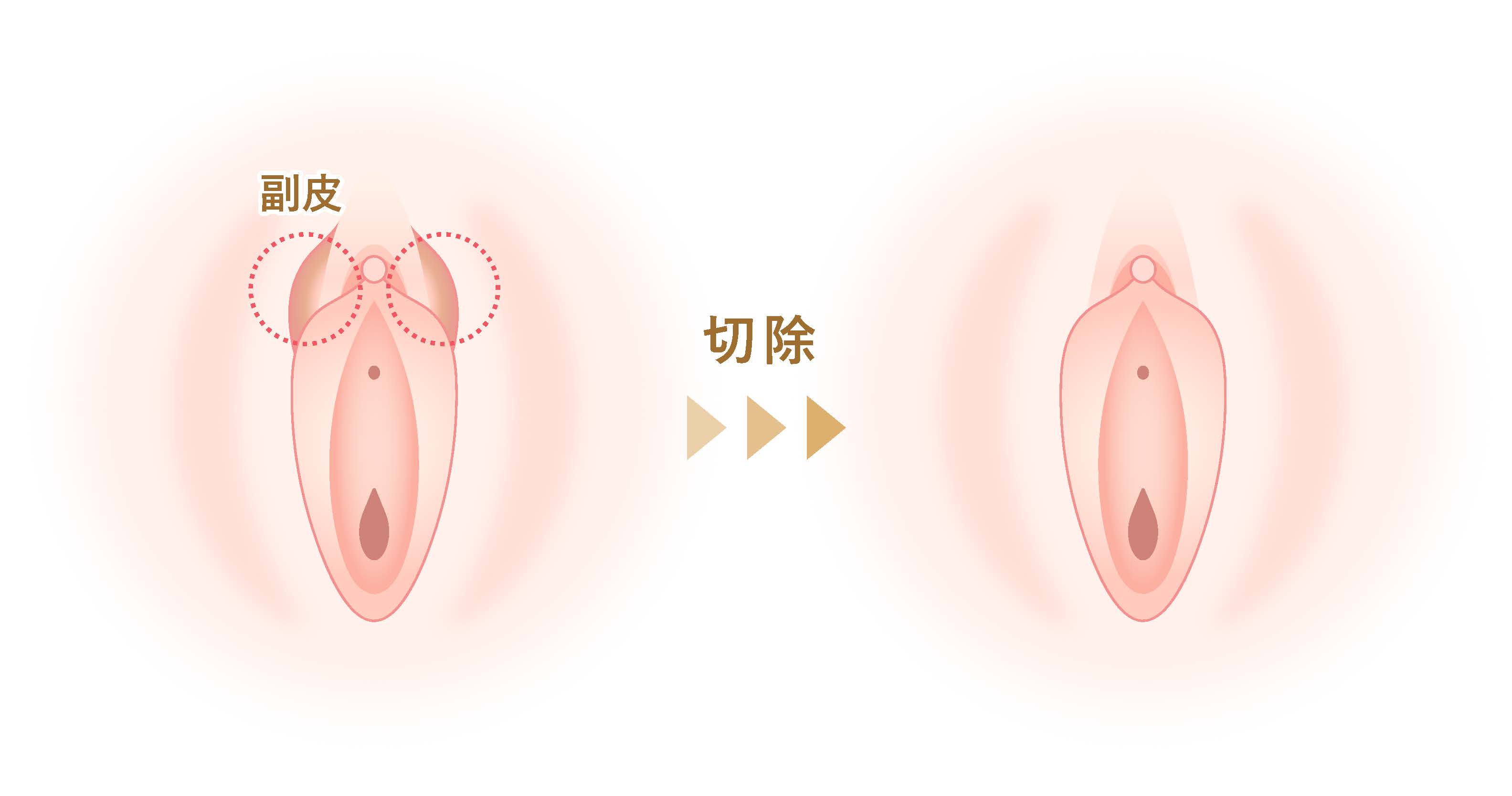 副皮切除のイラスト