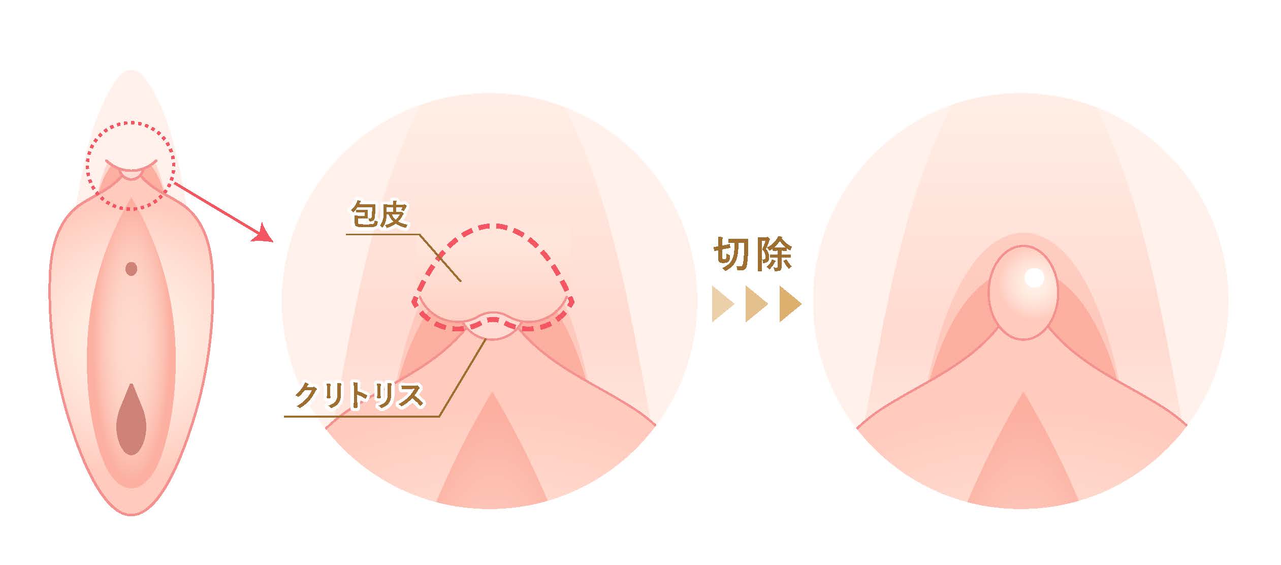 クリトリス包茎のイラスト